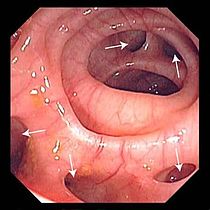 Lire la suite : La Sigmoidite Diverticulaire : Quand proposer une opération chirurgicale ?