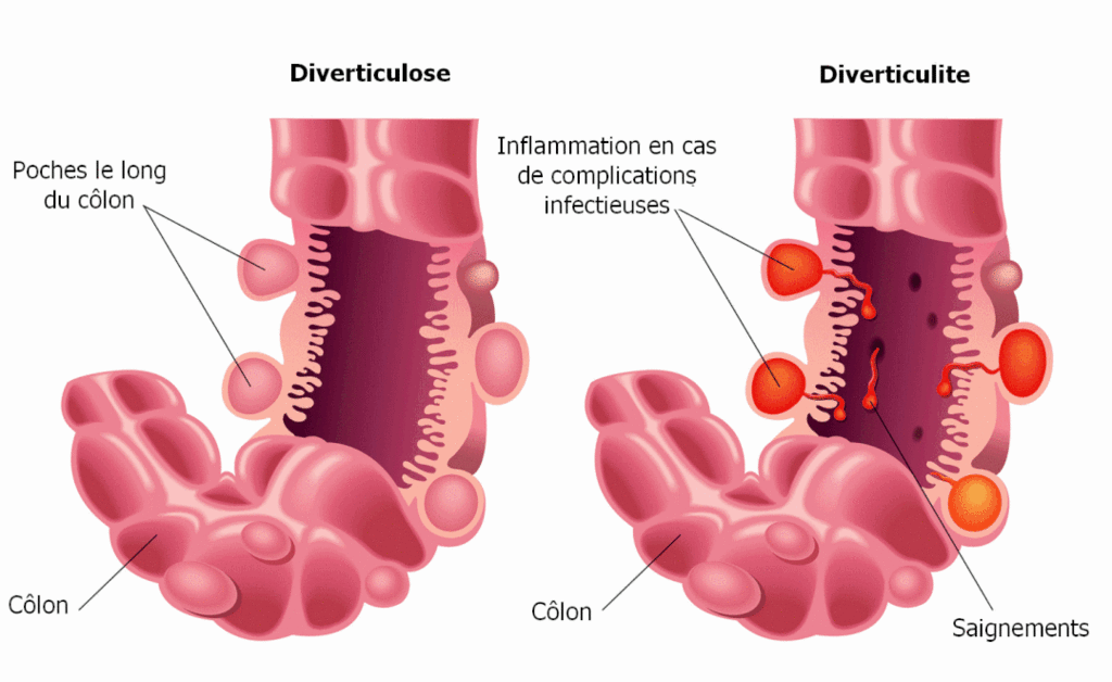 La Sigmoidite Diverticulaire : Quand proposer une opération ...